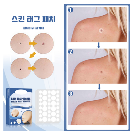 피부 제거 패치 얼굴 바디 피부 치료 라벨 스텔스 포장증정, 145매입, 2개